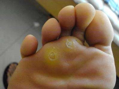 肉刺长什么样子图片