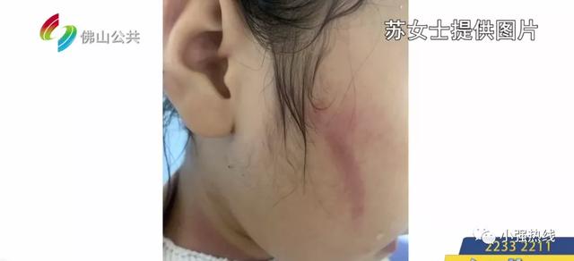 8岁女童在酒楼不慎滑倒，全身多处被烫伤化脓！妈妈：酒楼未做好防护措施