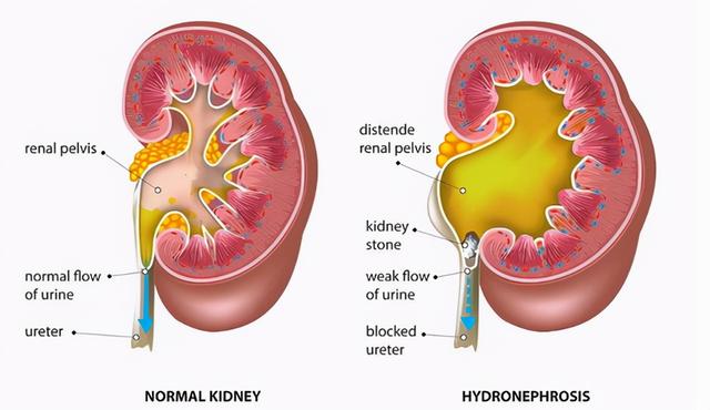 盐吃多了对身体不好！餐桌上的5种“高盐食物”，劝你和家人少吃