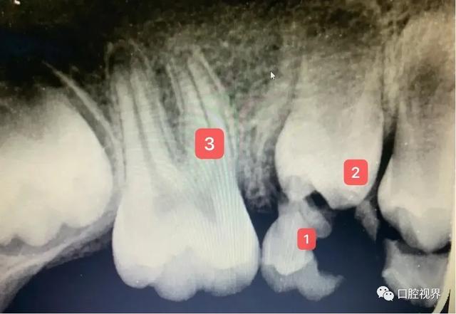 孩子拍牙片会损伤智商？真相是？