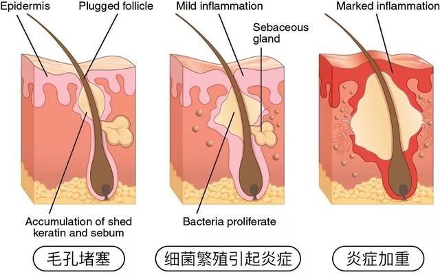 怎样才可以去痘痘