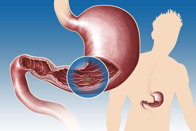 胃溃疡这几个信号大意不得