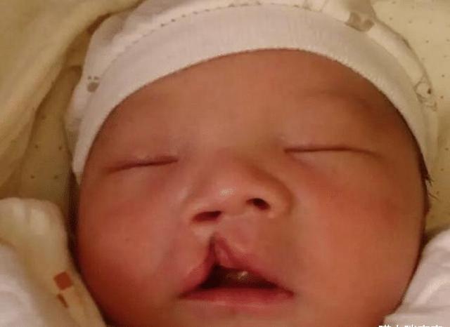 孕妇产下“兔唇宝宝”, 谎称孕期吃了兔肉，被医生揭穿