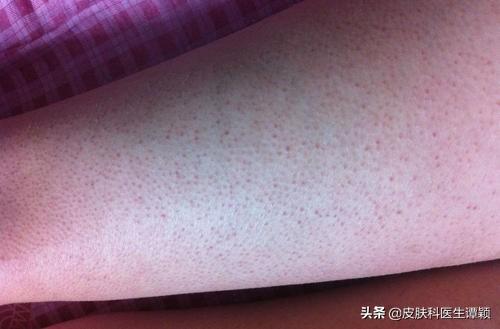 小孩子鸡皮肤怎么治疗