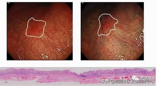 讲真 这5类人必须尽早做胃镜 全网搜