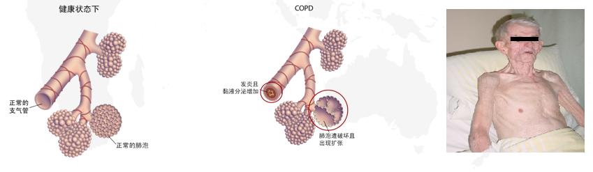 吸煙只會引起肺癌嗎？