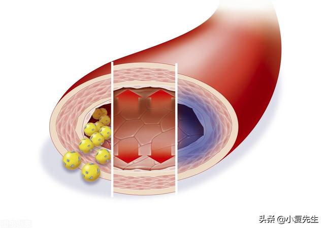 高血压的祸根不光是盐，注意：此3种肉常吃，警惕高血压并发症