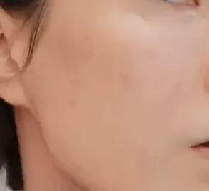 中药调理毛周角化症
