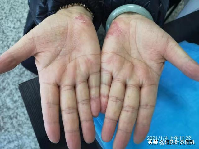 程凯养生说：心血不足，手上有表现