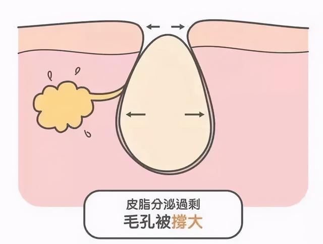水杨酸引起皮肤角化异常