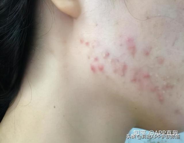 脖子上长毛周角化怎么