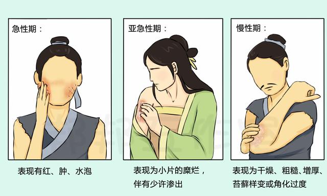 涂了身体乳可以涂炉甘石吗