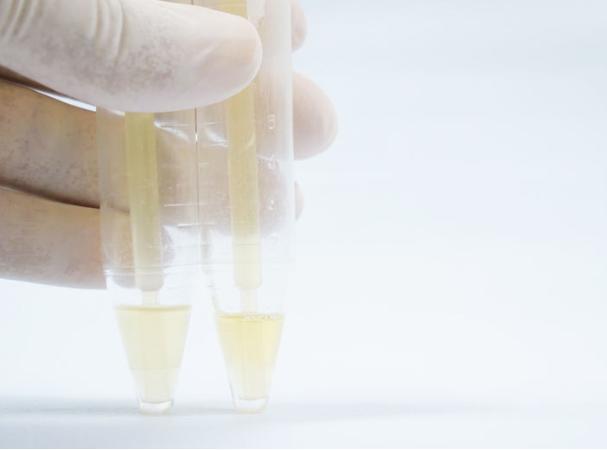 出现泡沫尿就是肾出问题了？未必，还有这几个因素，需要了解