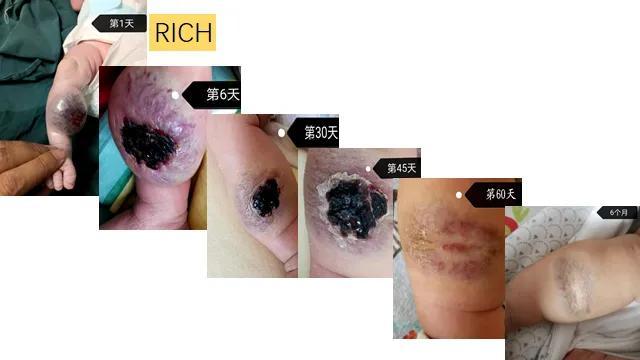 新生儿小腿巨大肿瘤，医生说不用治疗，结果几乎自愈