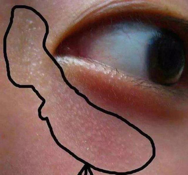 拿眼部的脂肪粒没办法?给你支个招