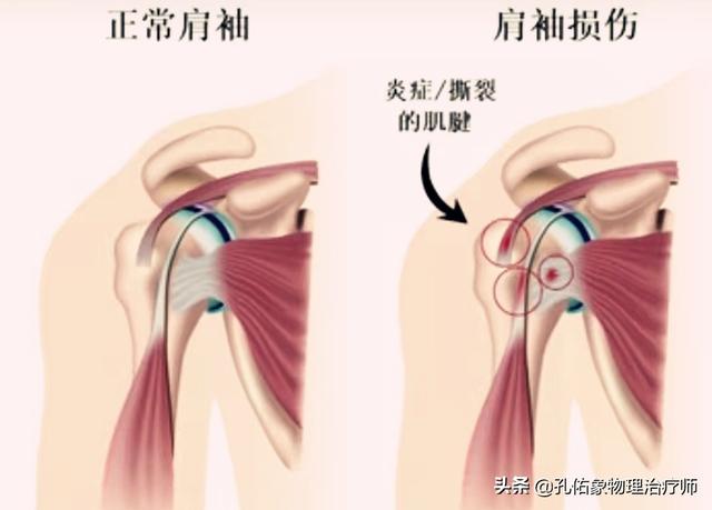 肩膀痛怎么办