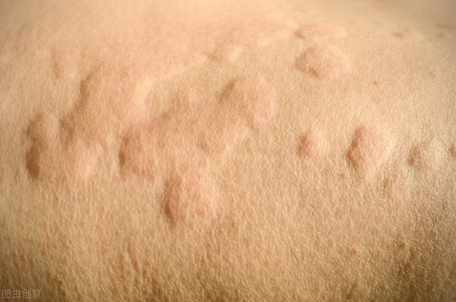 荨麻疹，瘙痒剧烈？3味中药，疏风止痒，有效解决瘙痒