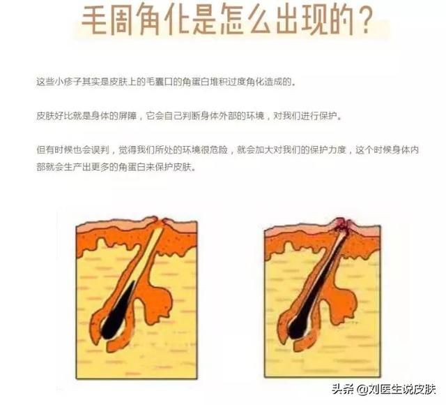 为什么有的皮肤是鸡皮