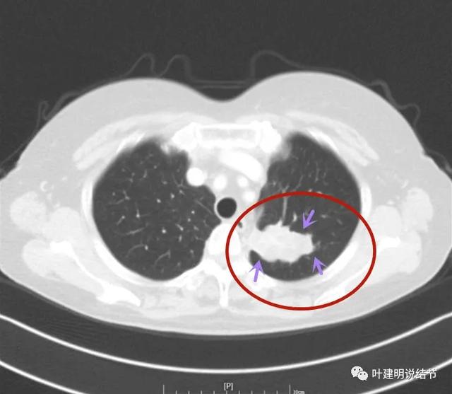 左肺占位进一步检查什么意思