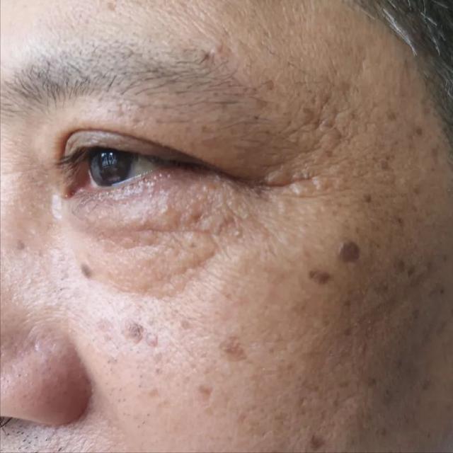 手心透明疙瘩点状角化病
