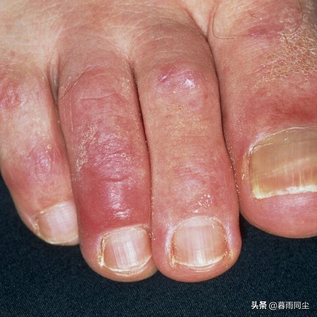 冬季背包客、戶外作業者，如何預防與處理失溫（體溫過低）和凍傷