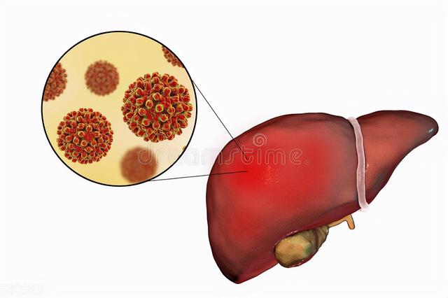 急性病毒性肝炎中医分三步治疗