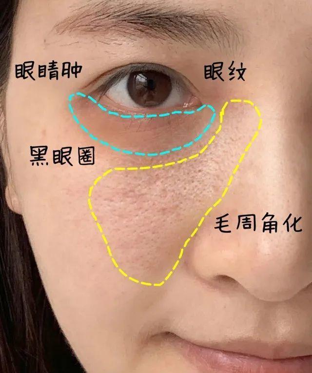 鸡皮痘痘是皮肤破损吗