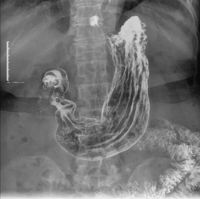这个钡餐的影像反映出胃的另一种形态