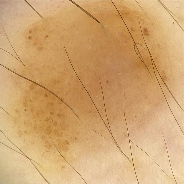手心透明疙瘩点状角化病