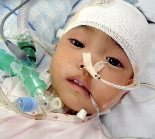 日本一岁八个月的孩子患脑肿瘤，开颅手术！失去声音「连载1」