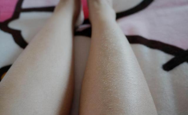 秋冬季节，每次脱裤子，腿上的白色皮屑是怎么回事儿？