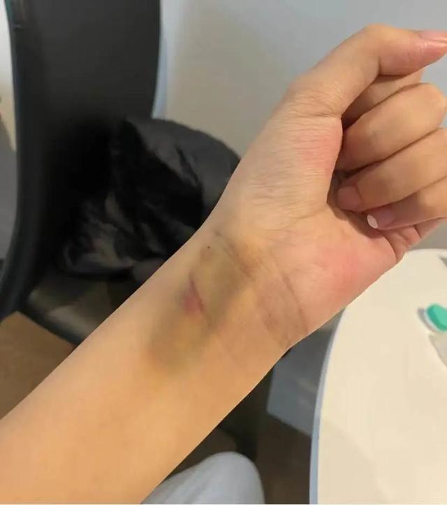 那个被下病危通知书的留学女孩