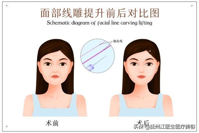 法令纹怎么去除最有效安全（特别严重的法令纹怎么改善）