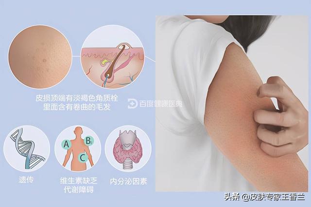 如何治鸡皮肤是什么样