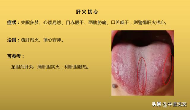 4种“热”藏于体内，不同舌象，不同症状，建议收藏分享给朋友