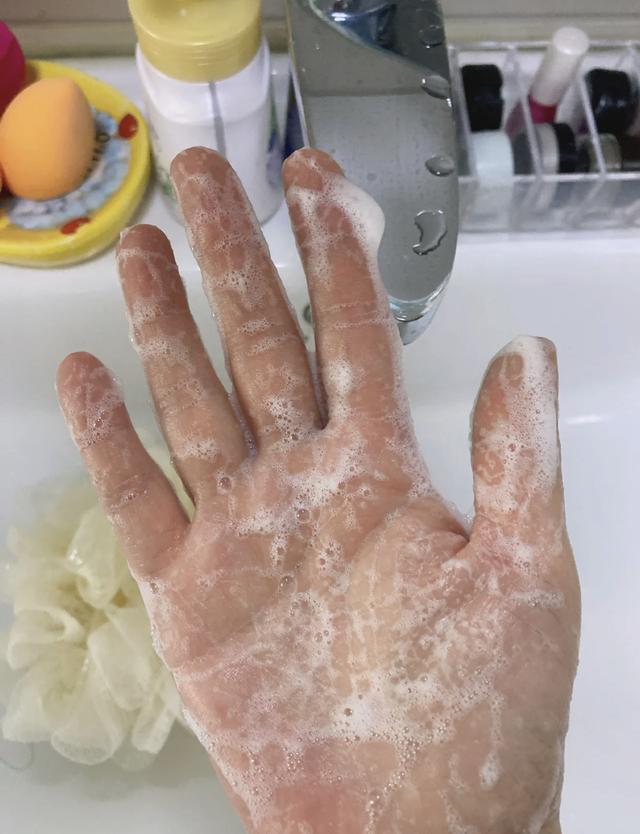 涂了身体乳还起皮怎么办