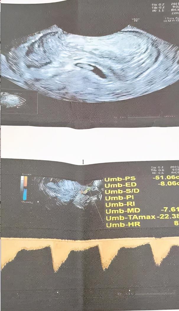 「保胎日记」多磨难迎来我的小天使，遇见木木真幸运