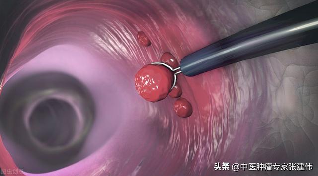 為什么第一次腸鏡檢查要放40歲?醫生：3個無癥狀的案例告訴你答案
