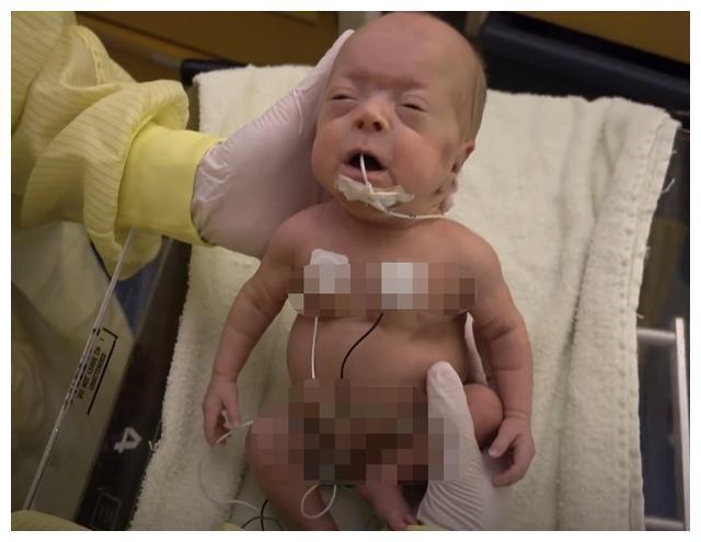 26周早产儿，出生不到1斤只有巴掌大，奇迹生还长成大美人