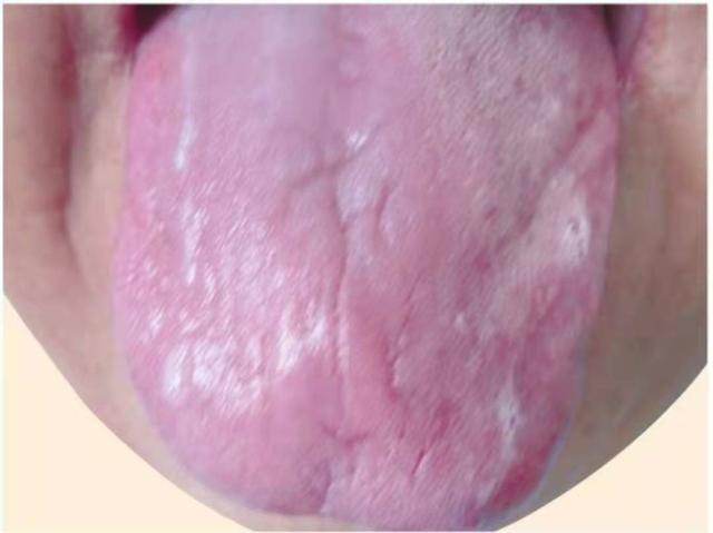 5种常见的失眠证型和舌象，老中医辩证施治，看看你是哪一种？