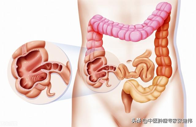 為什么第一次腸鏡檢查要放40歲?醫生：3個無癥狀的案例告訴你答案