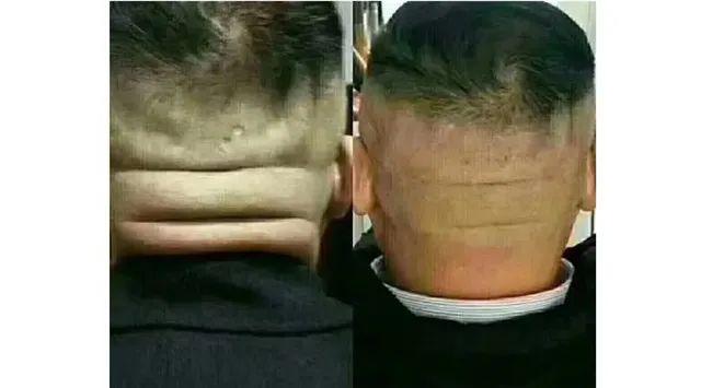 横纹是脑梗纹、竖纹是脑出血纹、凸起是炸药包，一定要及时疏通