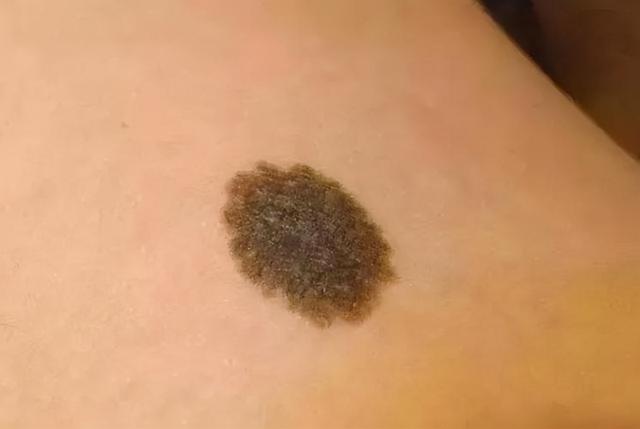 新生儿屁股有“淤青”是怎么回事？不是投胎时被踢，或与爸妈有关