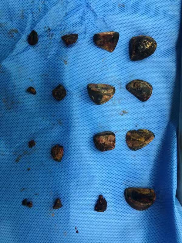 六旬翁胆结石多达16颗曾拖延不治！专家：反复刺激或引发癌症