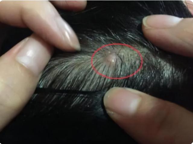 为什么头皮总长“脓包”和“疙瘩”？或许和4个原因有关