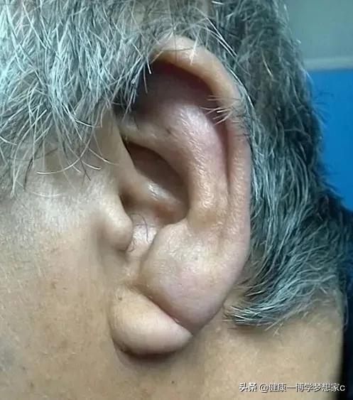 冠心病人耳垂折痕图片图片