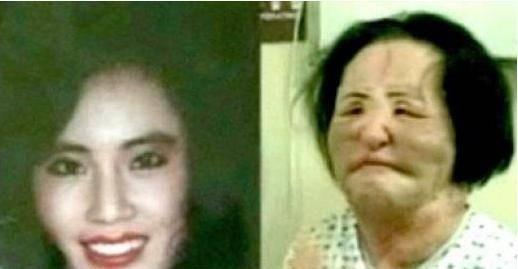韩慧景：把自己整成“电风扇”，注射食用油代价惨痛，我悔不当初