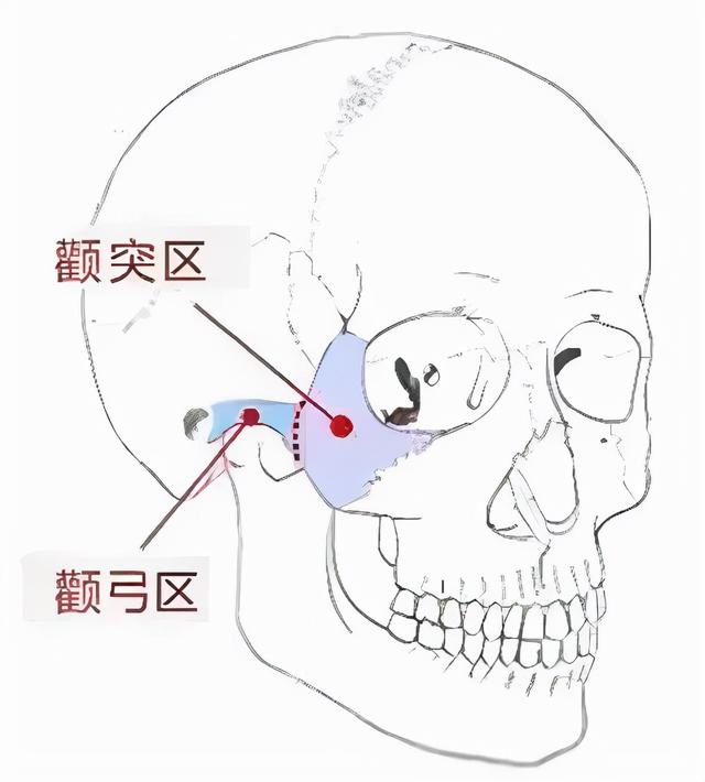 颧骨形态主要决定了中面部的脸型轮廓和宽度