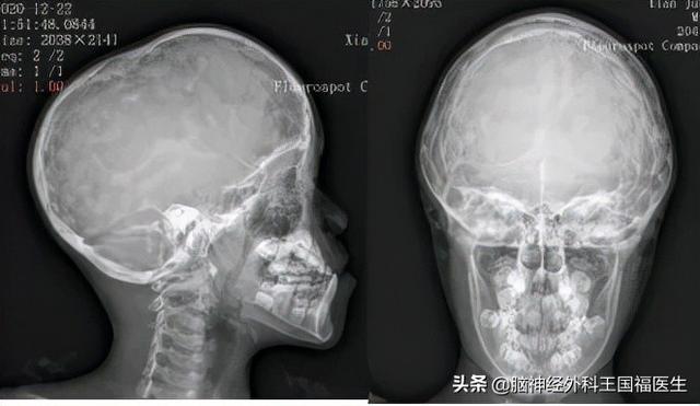 孩子忽然呆住持续1分钟，上课突然起身，是癫痫？!还有隐藏病因..