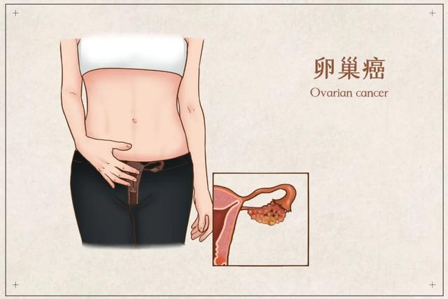 以為是懷孕，結果卻是癌癥晚期？